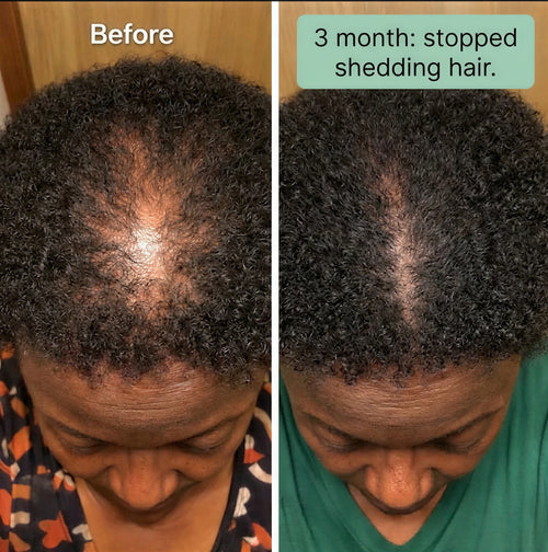Zypharo™ Hair Growth Spray