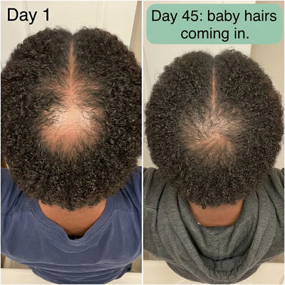 Zypharo™ Hair Growth Spray