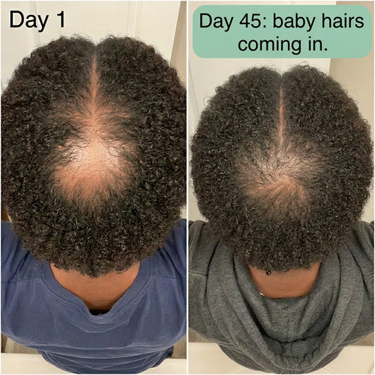 Zypharo™ Hair Growth Spray